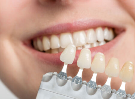 veneers Las Vegas