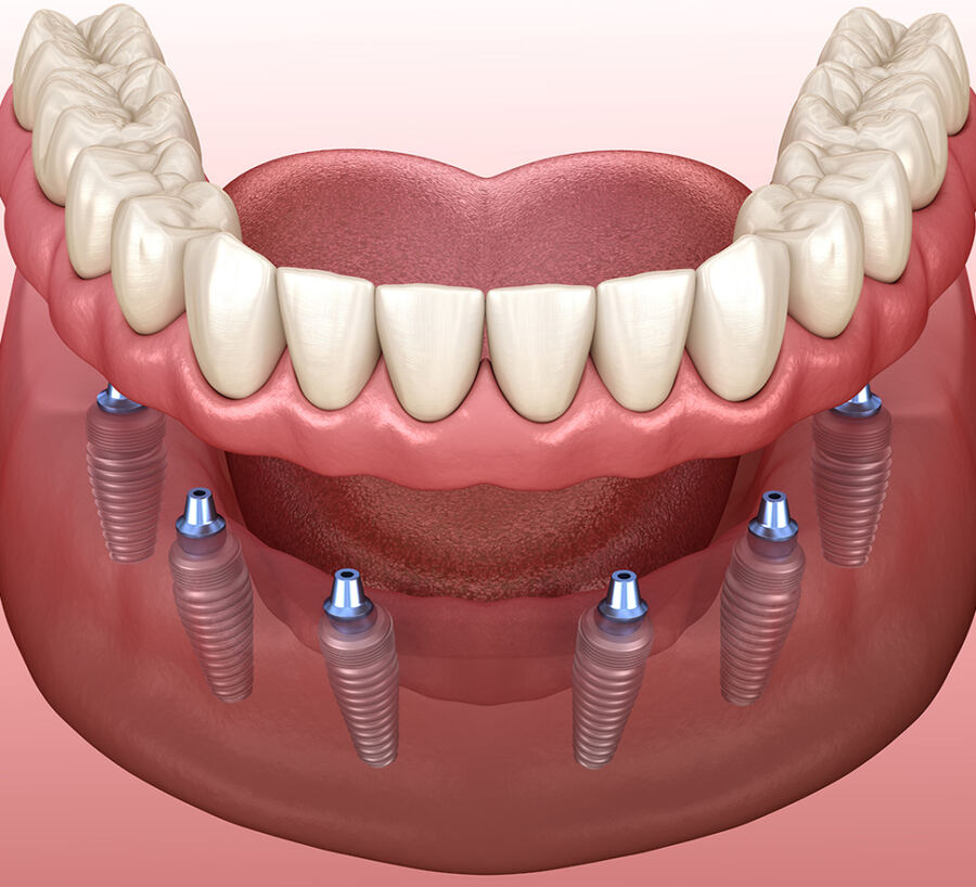 All on 6 Dental Implants in Summerlin, Las Vegas