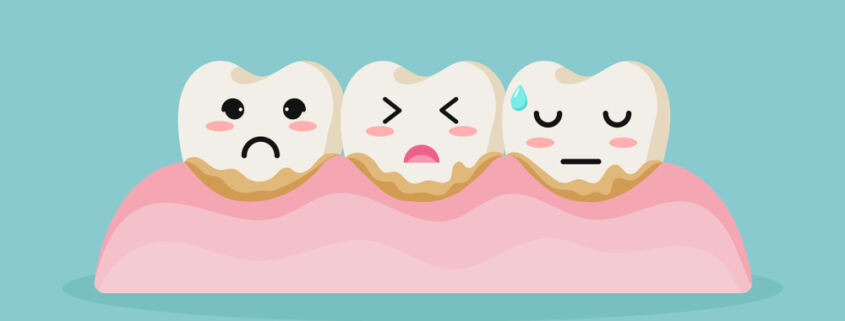 Black Tartar on Teeth