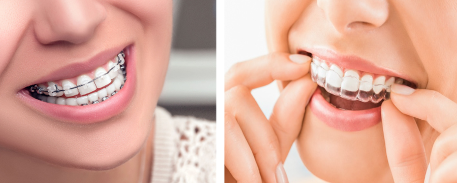 Braces alternatives