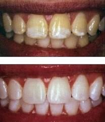 las vegas dental whitening.